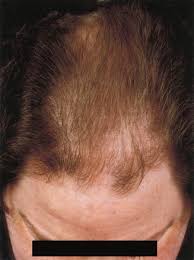 Hyperparathyroidism is an increase in parathyroid hormone (pth) levels in the blood. Hair Loss In Women With Hyperandrogenism Four Cases Responding To Finasteride Sciencedirect