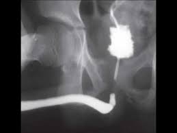 Image result for Retrograde Urethrogram