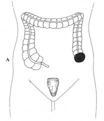 A suspected case of diverticulitis took me to the doctor in november 2014. Diverticular Disease Expanded Version Ascrs