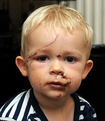 Children & People Injured & Killed in Dog Attacks