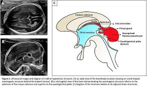 Poster Abstracts of the ISPD 27th International Conference on Prenatal  Diagnosis and Therapy, Edinburgh, United Kingdom, 19–21 June 2023 - 2024 -  Prenatal Diagnosis - Wiley Online Library