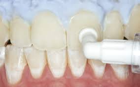 Sometimes called mottled enamel or enamel fluorosis, dental fluorosis occurs due to the sustained overconsumption of fluoride when the enamel layers of permanent teeth are being formed, even. Icon Caries Infiltrant Smooth Surface Dmg High Quality Dental Materials For Dentists And Dental Technicians