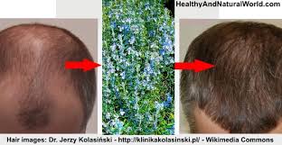 How To Use Rosemary For Treating Hair Loss