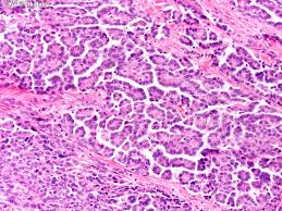 Sarcomatoid mesothelioma is a type of mesothelioma tumor made up of sarcomatoid cells. Malignant Epithelioid Mesothelioma Wild Country Fine Arts