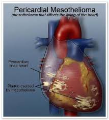 Pericardial mesothelioma is a highly lethal and very rare form of the cancer, accounting for roughly 1 percent to 5 percent of all new cases. Pin On Mesothelioma