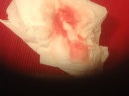Weird discharge at 26/27 weeks.reminds me of mucus plug. What Would You Do Bleeding 3 4 Weeks Pregnant Graphic Image Warning Added By Mnhq Mumsnet