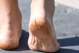 Dry Cracked Heels How To Treat This Painful Condition At Home Triad Foot Ankle Center