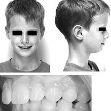 Intra-oral view: 3-mm deviation of the upper midline toward the right...