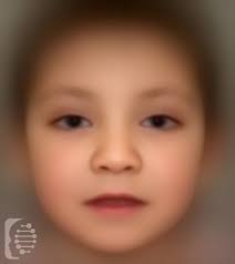 Down Slanting Palpebral Fissures Overview Causes