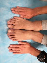 Image result for Clubbing nails feet