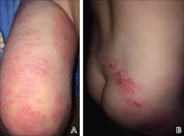 Image result for shingles in children