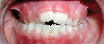 ∆ can invisalign clear aligners fix a crossbite? What Are The Effects Of Crossbites And How Can It Be Fixed Green Orthodontics