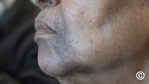 Image result for Diffuse Hyperpigmentation