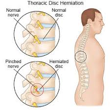 Does sitting worsen a herniated disc? Thoracic Disc Herniation What You Need To Know