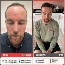 Watch Matthew Nicholas Callan who had a previous surgery in UK, sharing his  experience with us the day after his hair transplant surgery. We do  hundreds of corrections surgeries to people