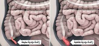 اجريت عملية مصران اعور وحصلت مضاعفات وبالتالي تمت اثناء العملية اجراء فصل امعاء (كولوستومي) وبعد شهر اجريت عملية ربط الامعاء. Ø§Ù„Ø²Ø§Ø¦Ø¯Ø© Ø§Ù„Ø¯ÙˆØ¯ ÙŠ Ø© Ø§Ø³ØªØ¦ØµØ§Ù„Ù‡Ø§ Ù„Ø§ ÙŠØ¤Ø«Ø± ÙÙ…Ø§ ÙØ§Ø¦Ø¯ØªÙ‡Ø§ Ø§Ù„Ø±Ø§ÙŠ
