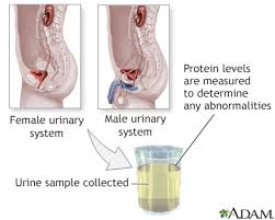 Image result for Isolated Proteinuria