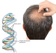 In the end, the group using sult1a1 with minoxidil showed a 75% hair regrowth response rate among participants (9 out of 12), whereas the group using minoxidil with placebo showed a 33% hair regrowth response rate among participants (4 out of 12). What S The Connection Between Dna And Hair Loss Endhairloss Eu