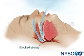 Image result for Obstructive Sleep Apnea