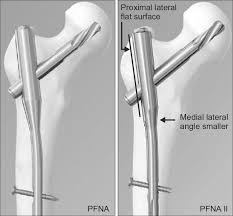 Proximal femoral nail antirotation (PFNA) is proximally ...