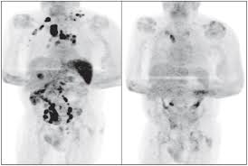 What if i change my behavior to eliminate a risk factor (for example, quit smoking or lose. Cancer Patient Goes Into Spontaneous Remission After Covid 19 Infection Sciences