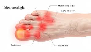 Image result for Metatarsalgia