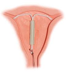 Cramps can increase no matter. Hormonal Iuds Wikipedia
