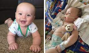 Image result for Infant Botulism