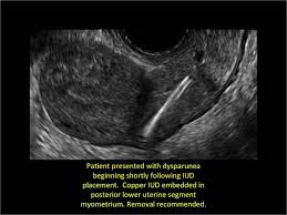Learn vocabulary, terms and more with flashcards, games and other study tools. How To Identify And Localize Iuds On Ultrasound Mdedge Obgyn