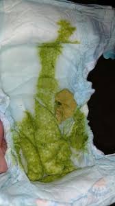 What is clay colored stool, causes and treatment. Pale Poop After Stomach Bug Pic Included Babycenter