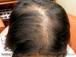 This is an uncommon side effect of bupropion, the same active ingredient in both the brand and generic formulations. Balding 22 Year Old Woman With Photos Wrassman M D Baldingblog