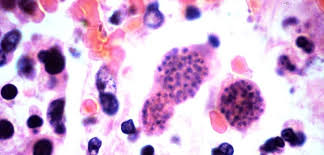 But it's totally possible for both types of herpes simplex to infect either area. Herpes Simplex Penyebab Gejala Dan Pengobatan