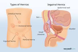 Image result for stomach hernia symptoms