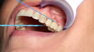 Placing dental implants is generally a relatively painless procedure when done by an expert dental implant specialist. Dental Implants Aftercare Guide The Implant Centre Sussex