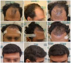 Hair Transplant In Chandigarh Hair Transplant Hair Transplant Results Hair Transplant Cost