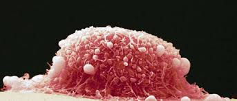 Laporan efek samping dari kelainan serviks dan kanker serviks terjadi empat hingga lima tahun setelah vaksinasi hpv, dan telah meningkat pesat antara 2011 dan 2012. Bahaya Kanker Serviks Bisa Dicegah Dengan Vaksinasi Hpv