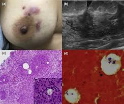 Mastitides) refers to inflammation of the breast parenchyma, of which there are a number of subtypes: Cystic Neutrophilic Granulomatous Mastitis Corynebacterium Species Associated Infection With Distinct Histology Clinical Microbiology And Infection