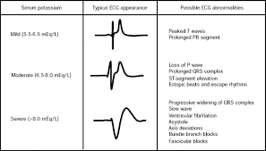 Hyperkalemia Physiopedia