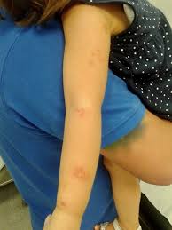 Es la primera vez que veo los estratos cinco y seis angustiados, y. Revista De Pediatria De Atencion Primaria Herpes Zoster Tras Primera Dosis De Vacuna De Varicela En Paciente Inmunocompetente