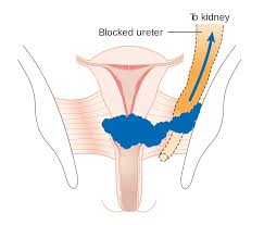 Pelvic floor dysfunction is a common condition where you're unable to correctly relax and coordinate the muscles in your pelvic floor to urinate or to have a bowel movement. File Diagram Showing Stage 3b Cervical Cancer Cruk 226 Svg Wikimedia Commons
