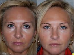 Den sitter ikke utenpå øyet. Behandling Av Tear Trough Med Restylane Beautyblogg