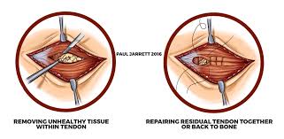 It is a painful condition that occurs when tendons in your elbow are overloaded, usually by repetitive motions of the wrist and arm or commonly known as an overuse injury. Mr Paul Jarrett Epicondylitis Tennis Elbow Golfer S Elbow Murdoch Orthopaedic Clinic