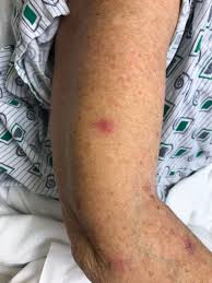 Image result for Pyoderma Gangrenosum