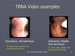 Diagnosis was made on the tbnaslides and cell block/biopsy material. Transbronchial Needle Aspiration Techniques Ppt Video Online Download