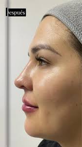 Armonización facial con ácido...