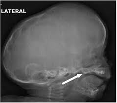 The sulphur dioxide escaping from the melt gets trapped in the cooler parts of the surface giving a blistery appearancefor copper and hence it is called blister copper. Crouzon Syndrome