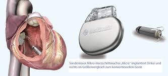 Ein icd besteht im prinzip aus zwei komponenten. Device Implantation Medizinische Klinik Ii Kreisklinik Ebersberg