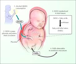 Foetal alcohol syndrome is completely avoidable if you do not drink alcohol while you're pregnant. Fetal Alcohol Spectrum Disorder Cmaj