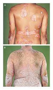 Methotrexate Versus Cyclosporine In Moderate To Severe Chronic Plaque Psoriasis Nejm