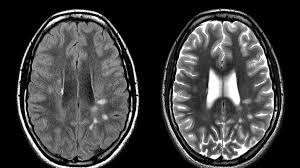 La sclerosi multipla o anche sclerosi a placche è una malattia autoimmune che colpisce il sistema diagnosi: Cosi La Risonanza A 3tesla Svelera La Sclerosi Multipla La Stampa